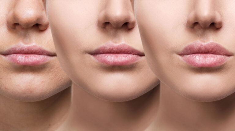 Lip Filler 101: Your quick guide to getting luscious lips in Singapore