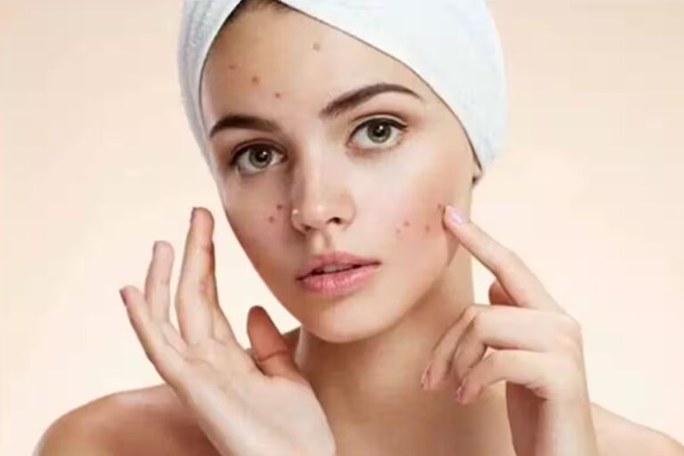 Unveiling Your Best Skin: Expert Tips for Clearing Acne and Dark Spots